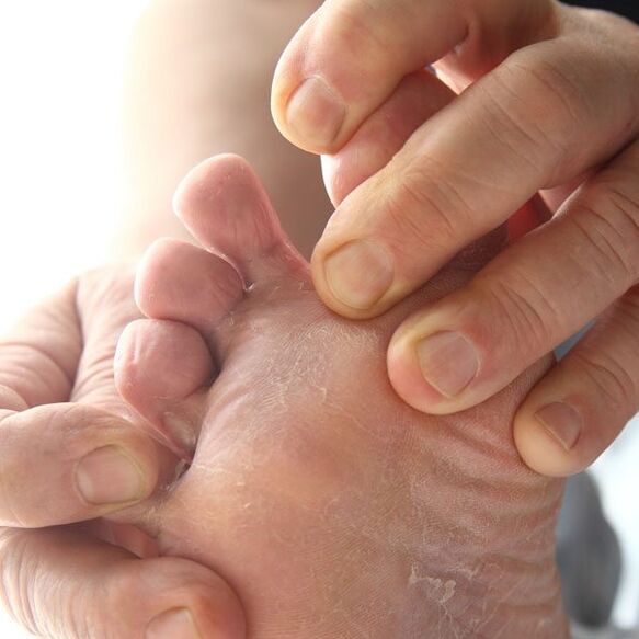 Fungus affects the skin between the toes