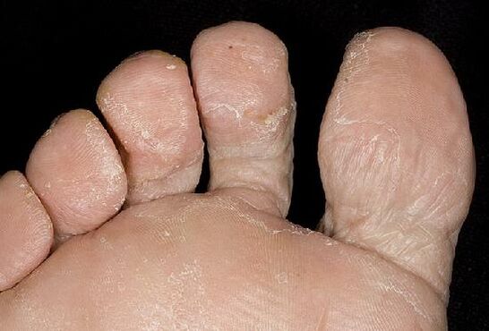 Symptoms of foot fungal infection