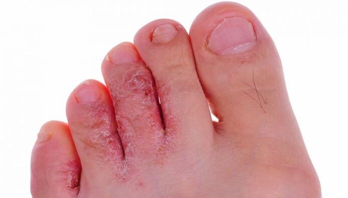 Fungal skin infection on toes