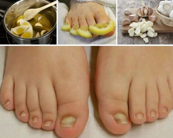 Folk remedies for nail fungi
