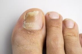 Fungal diseases
