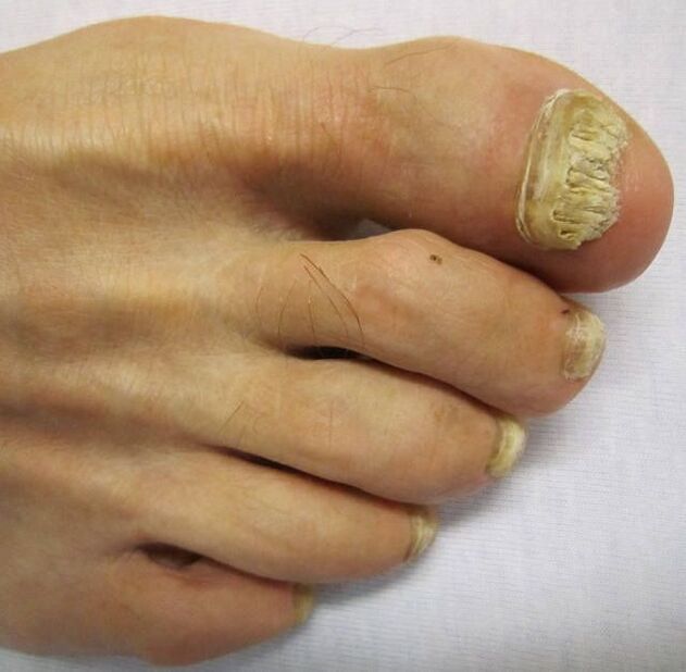 Damage to nails