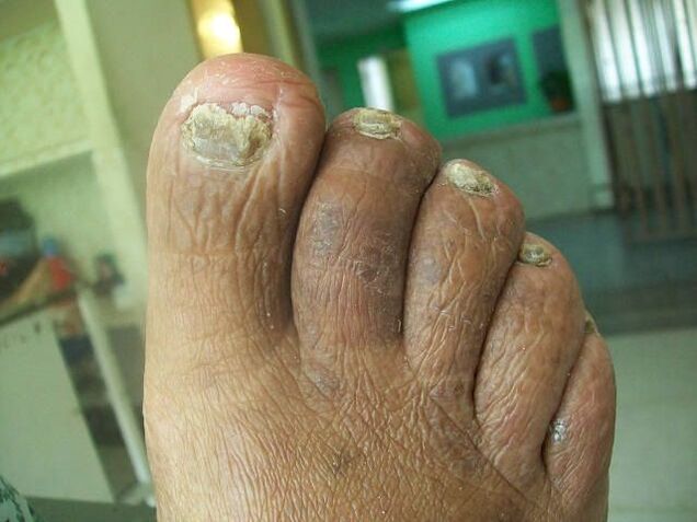 Fungal lesions