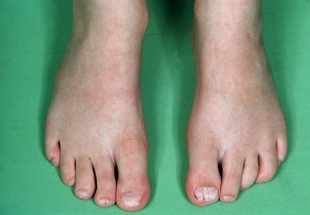 Fungus on the legs