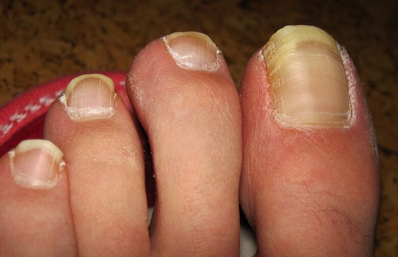 Fungus turns toenails yellow