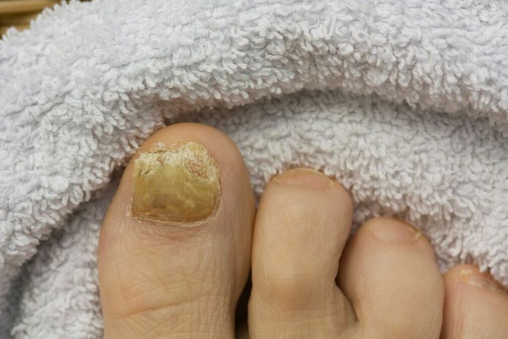Fungal atrophy stage (fall off toenails)