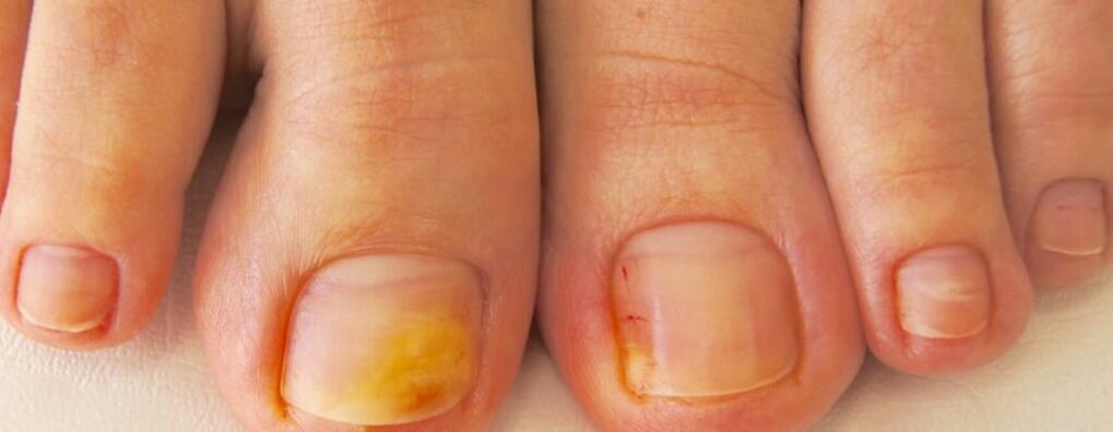 Initial stage of onychomycosis - yellowing of toenails