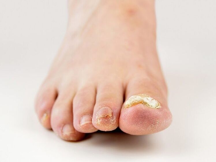 Nail plate on big toe thickened by fungus
