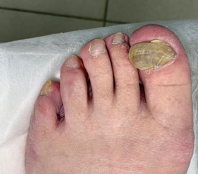 leg deformity nail hypertrophic onychomycosis