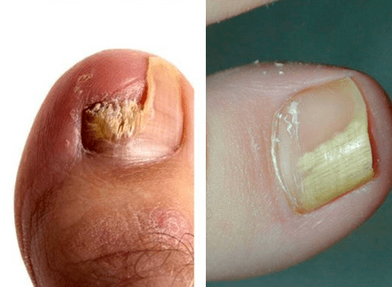 Fungal Diseases