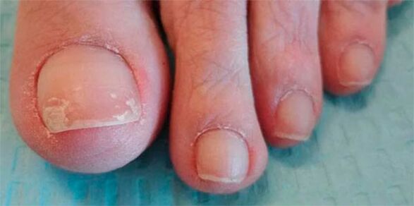 The stage of fungal legs