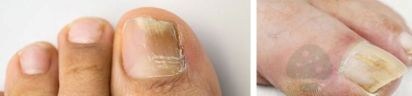 Nail fungus on the thumb on the leg
