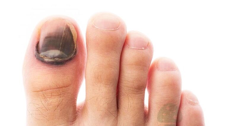 The operation stage of the disease, the thumbnail fungus