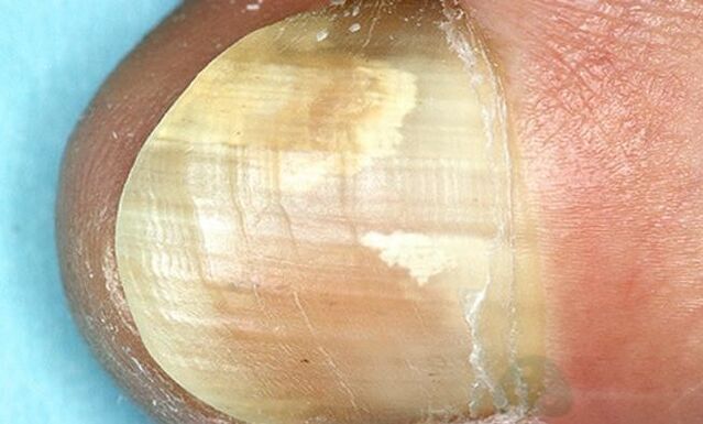 Treat fingertip fungi with internal action drugs