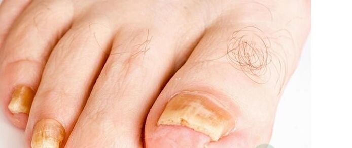 Variety of fingernail fungi