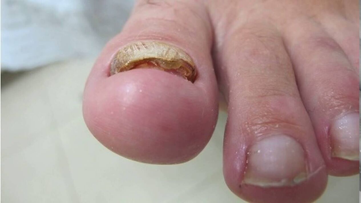Hypertrophic fungus – edge deformation, discoloration and nail plate thickening