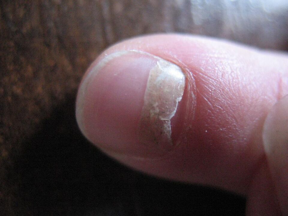 Pine nail fungus associated with nail plate loss