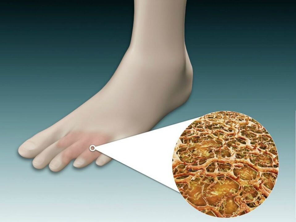 Redness of the skin between and near the toes due to intertriginous fungus