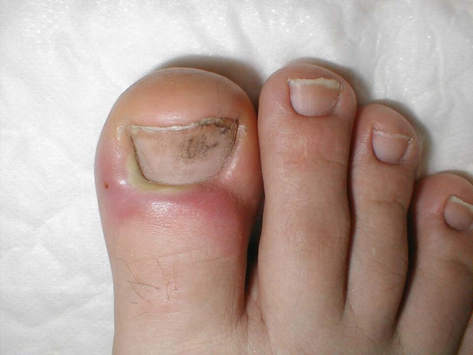 Spots and black streaks of normal vegetative fungus on the nail plate