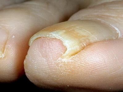 What a fungal toenail infection looks like
