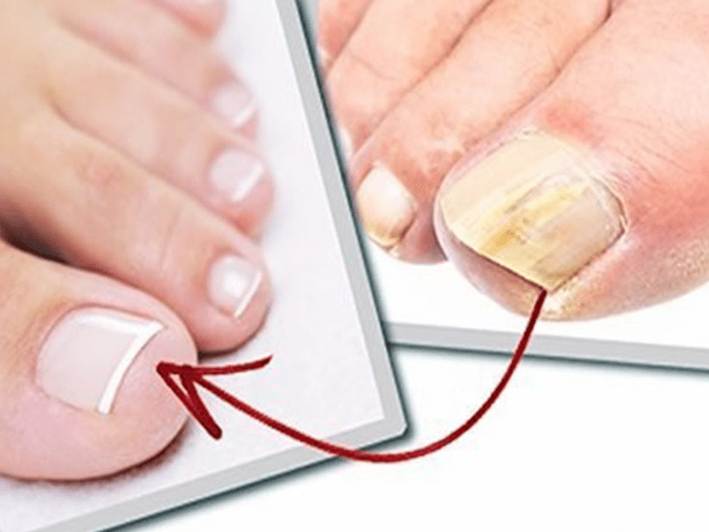 Fungus affected toenails and healthy nails after home treatment