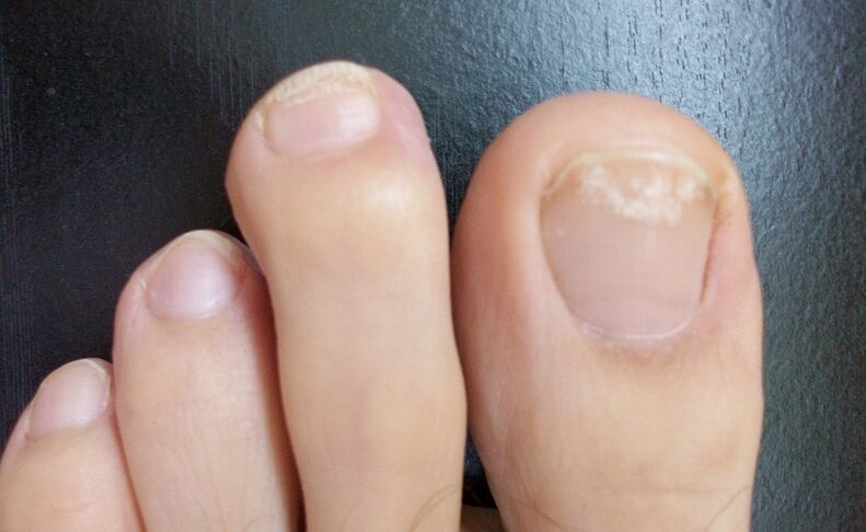 The first signs of fungus are color changes and spots on the nail plate